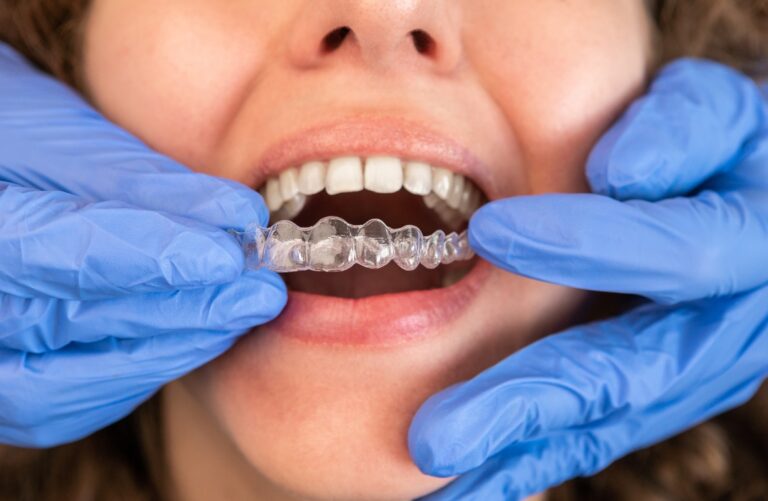 Braces and Invisalign