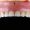 Maxillofacial Prosthesis